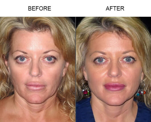 LazerLift® Treatment Before And After