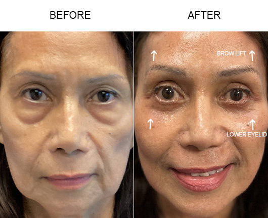 Lower Eyelid Surgery Before And After