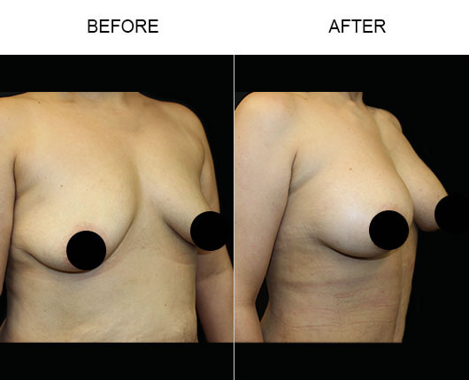 Breast Augmentation Surgery Before & After