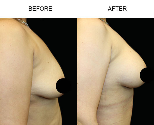 Before And After Breast Augmentation Surgery
