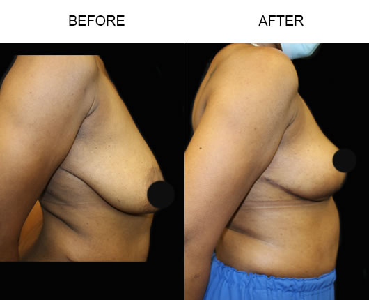 Before & After Breast Lift