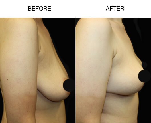 Breast Lift Surgery Before And After