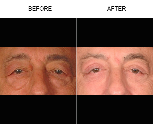 Upper Eyelid Surgery Before & After