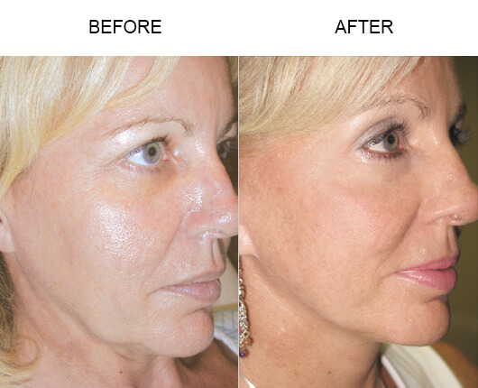 Facelift Surgery Before And After
