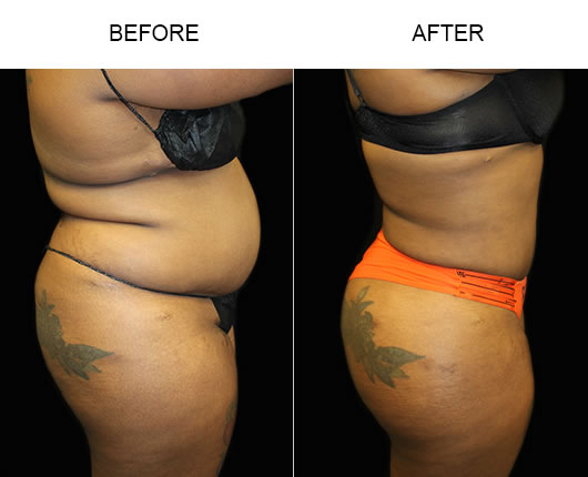 Before And After Liposuction