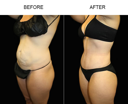 LowCut Tummy Tuck Results