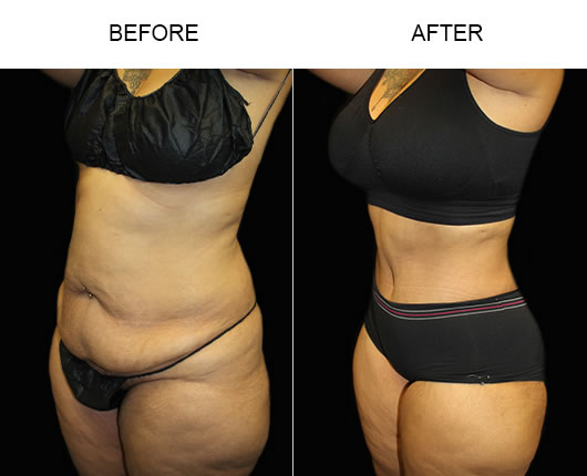 Low Cut Tummy Tuck Before & After