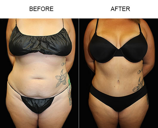 LowCut Abdominoplasty Before And After