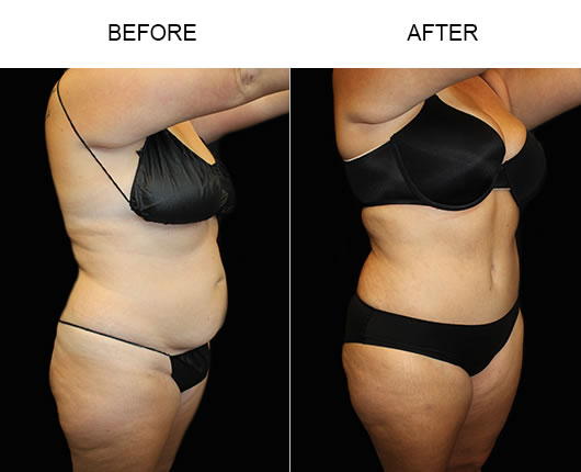 LowCut Abdominoplasty Before & After