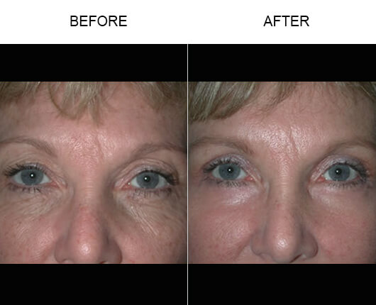 Eyelid Ptosis Surgery Results