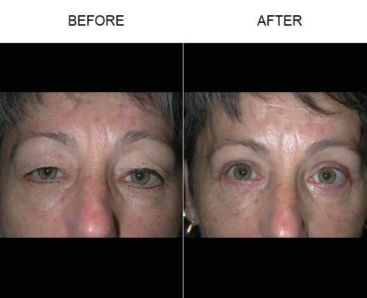 Drooping Eyelid Treatment Before And After