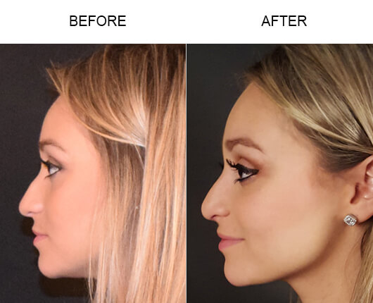 Tampa Before And After Rhinoplasty Surgery