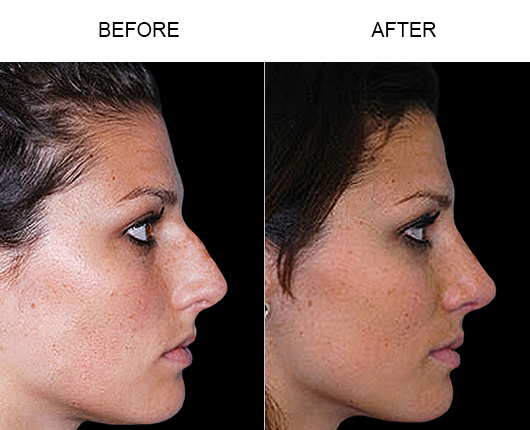 Before And After Rhinoplasty Tampa
