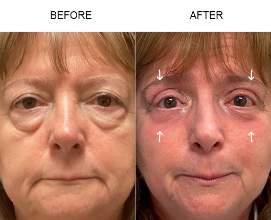 Lower Eyelid Surgery Before And After
