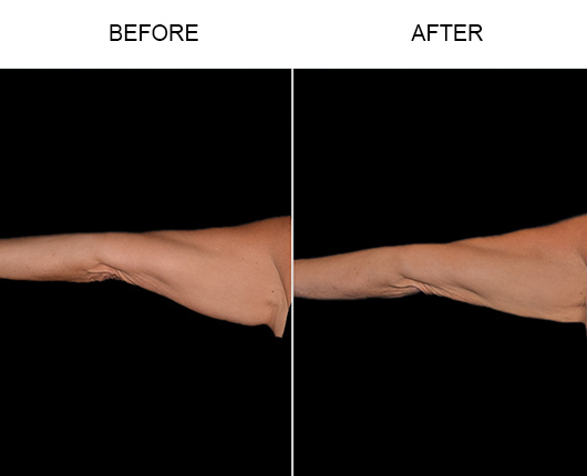 Bodytite Surgery For Arms Before & After