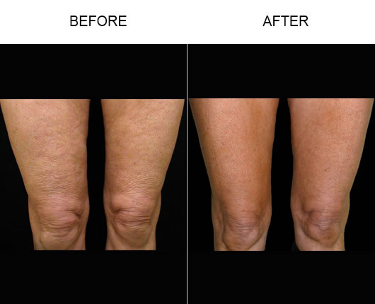 Before And After Bodytite Treatment