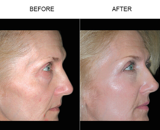 Cheek Lift Surgery Before And After