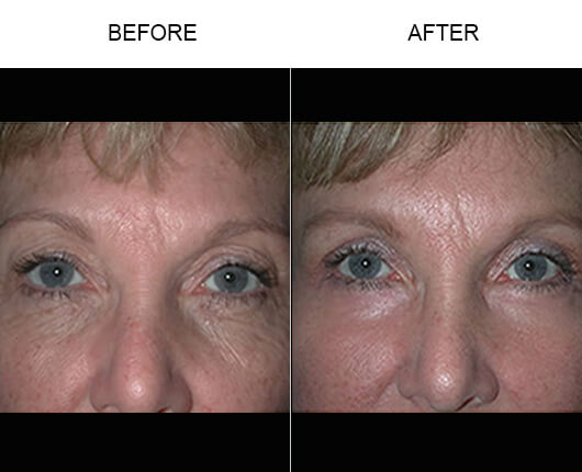 Upper Eyelid Surgery Results