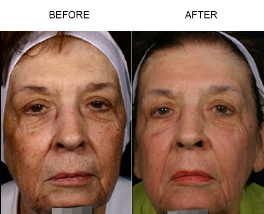 Facial Laser Treatment Results