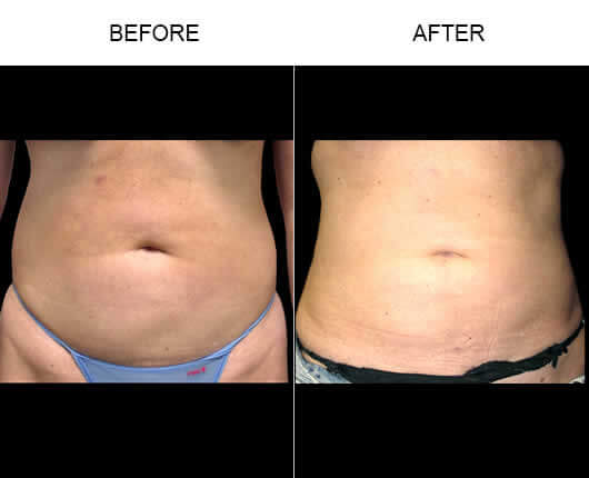Aqualipo® Body Sculpting Before And After