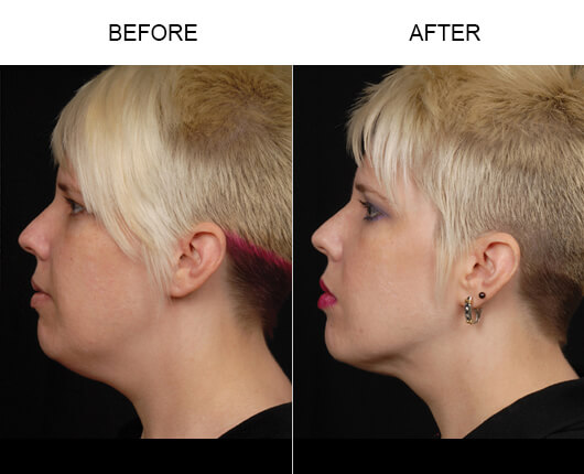 Facial Lipo Before And After