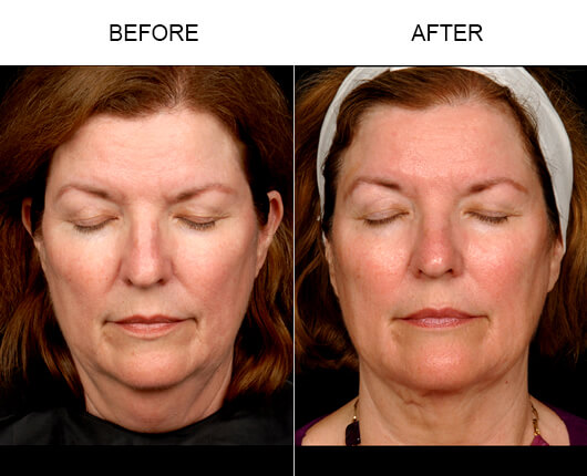 Facial Liposuction Results