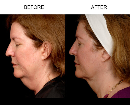 Face Liposuction Results