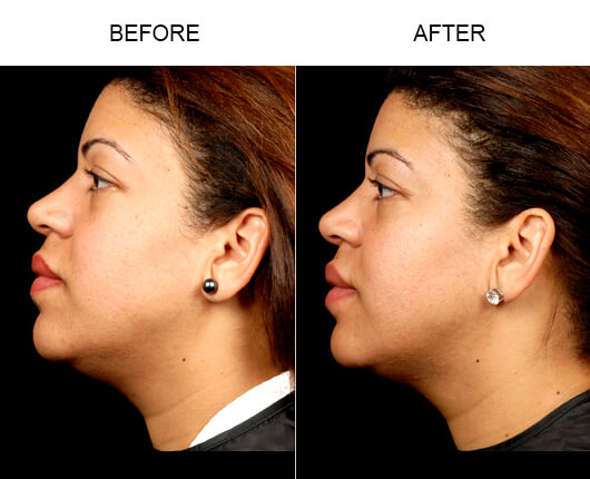 Face Lipo Before And After