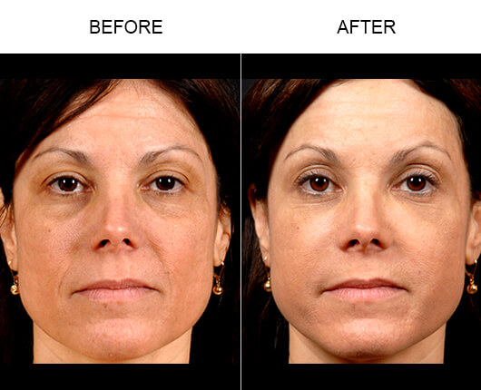 Naturalfill® Facial Filler Before And After