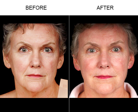 Naturalfill® Facial Filler Results