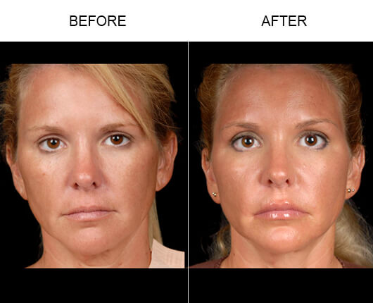 NaturalFill® Face Wrinkle Treatment Results