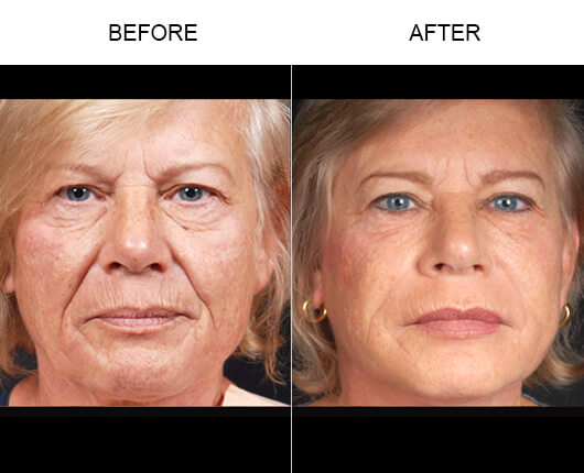 Natural Facial Fillers Before And After