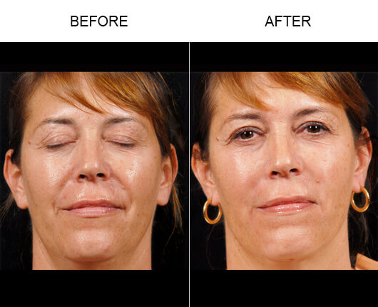 Facial Line Treatment Results