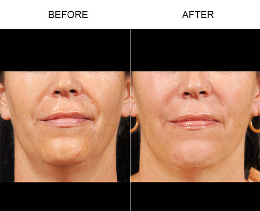 Facial Line Treatment Before And After