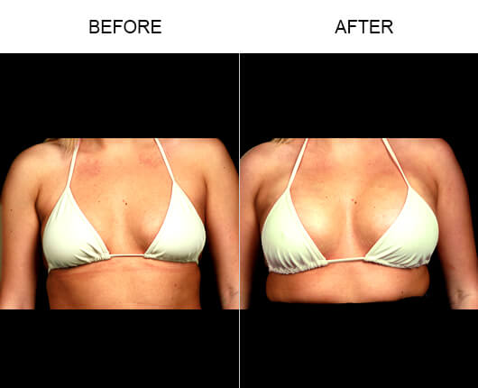 NaturalFill® Natural Breast Enhancement™ Before And After