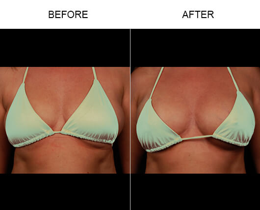 Natural Breast Enhancement Before And After