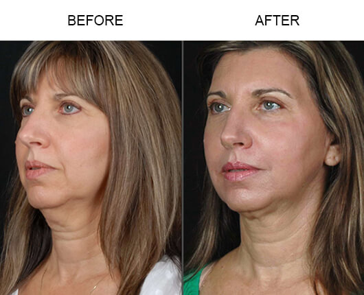 Laser Facelift Treatment Before And After