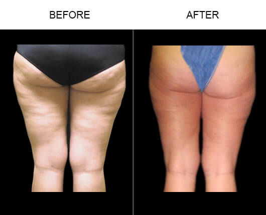Cellulite Treatment With Cellulaze™ Results
