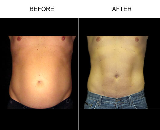 Smartlipo™ Before And After