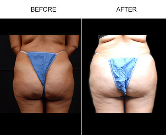 Buttocks Enhancement Before And After