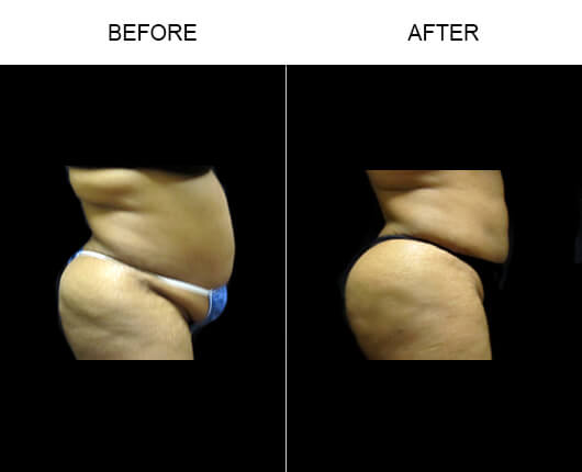 Buttocks Enhancement Results