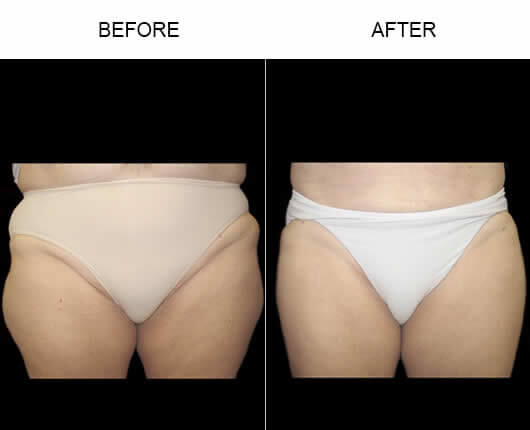 Body Contouring Before And After