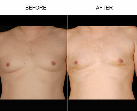 Aqualipo® Body Contouring Before And After