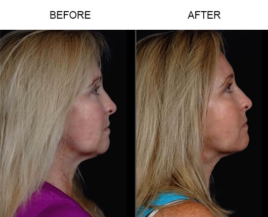 Laser Facelift Procedure Before And After