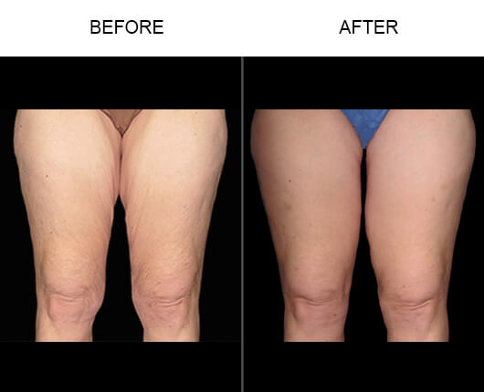 Thigh Lift Before And After