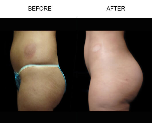 Naturalfill® Buttocks Enhancement Before And After