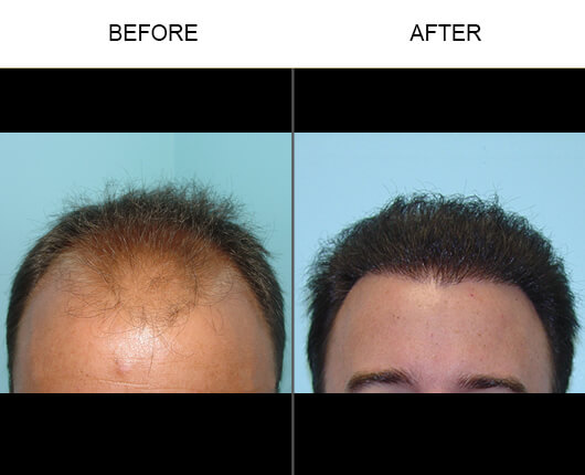 Hair Transplant Florida Before and After