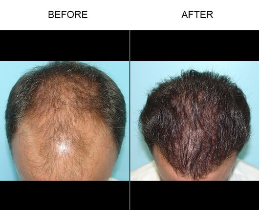 Hair Restoration Florida Before and After