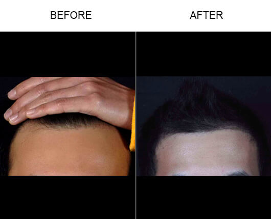 Hair Restoration Orlando Before and After