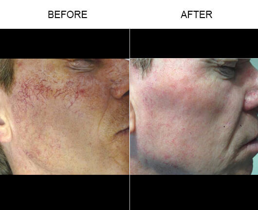 Vein Removal Before And After